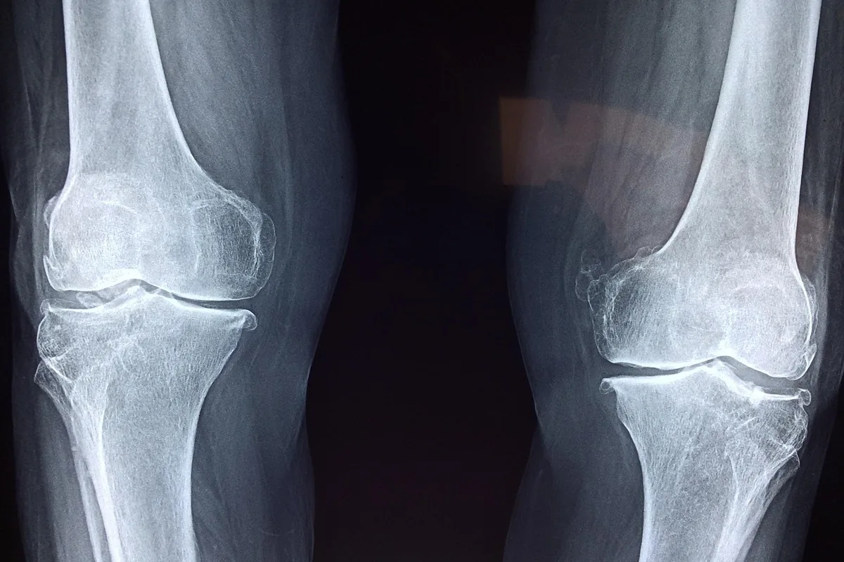 Douleur articulaire & arthrose : solutions naturelles | Alphavital 12 Modèle anatomique d'une articulation du genou montrant le cartilage entre les deux os