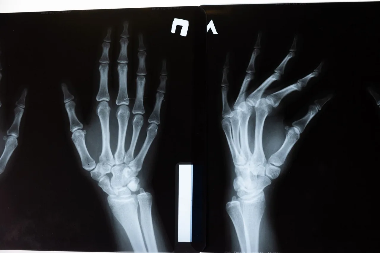 Vitamine D3 & K2 au Maroc : os, immunité & dosage — le décryptage 8 Radiographie symbolique d'une ossature solide – la vitamine D et K contribuent au maintien d'une ossature normale